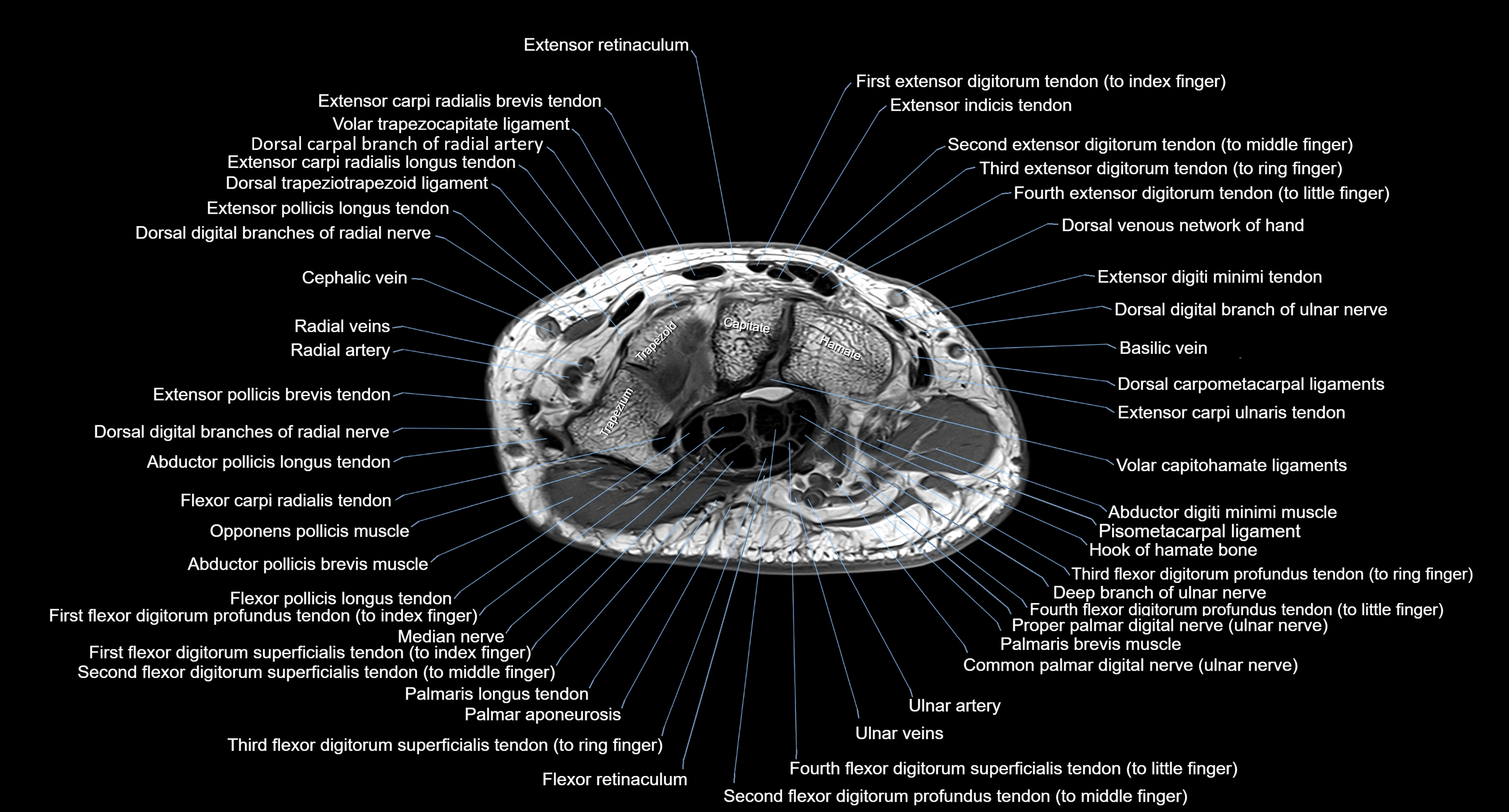 MRI wrist axial cross sectional anatomy 3T radiology  image-img-00001-00013.webp